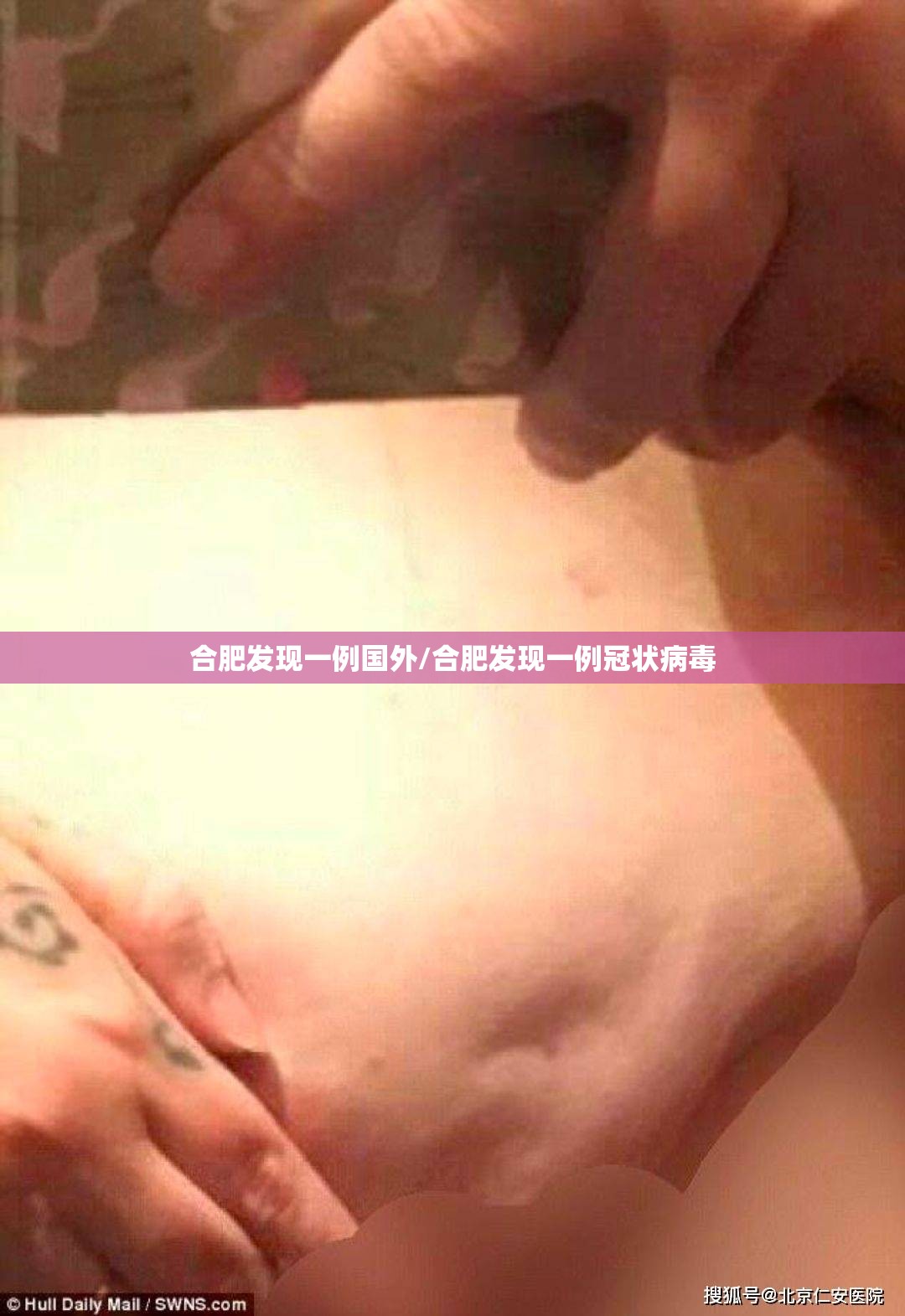 合肥发现一例国外/合肥发现一例冠状病毒