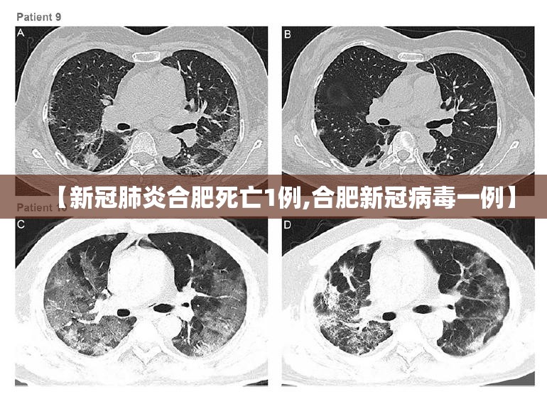 【新冠肺炎合肥死亡1例,合肥新冠病毒一例】