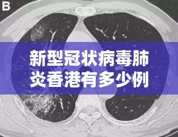 新型冠状病毒肺炎香港有多少例:香港新冠病例新增多少例