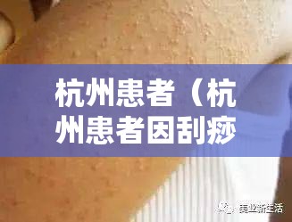 杭州患者（杭州患者因刮痧后皮肤淤紫报警事件）