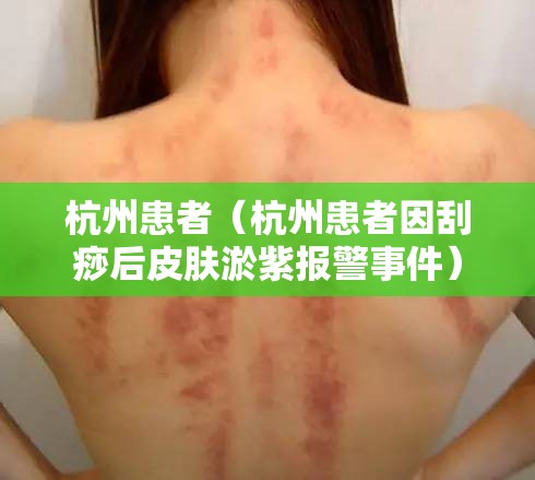 杭州患者（杭州患者因刮痧后皮肤淤紫报警事件）